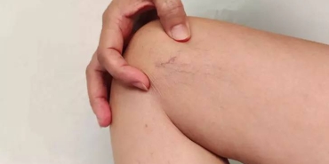 uzmani-acikladi-lipodem-selulit-gibi-yuzeysel-bir-kozmetik-sorun-degil-RUtDJSqt.webp